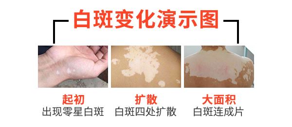 怎么去除皮肤黄斑和白斑